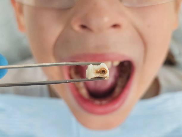 Best Emergency Tooth Extraction in Ronceverte, WV
